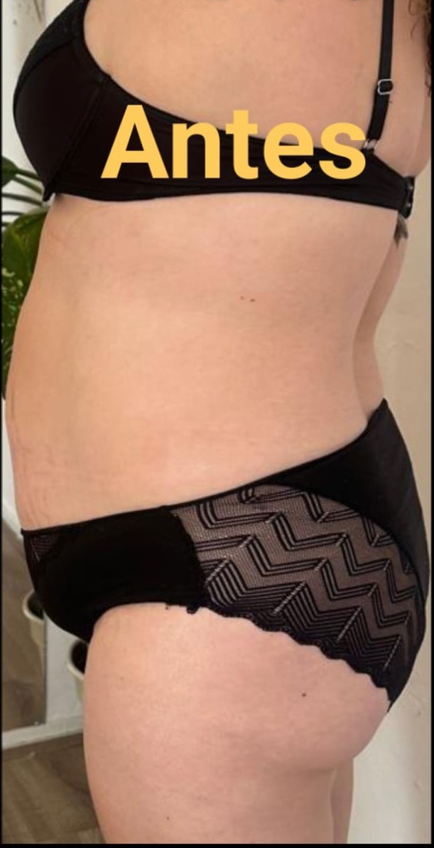 Antes del tratamiento de glúteos y caderas