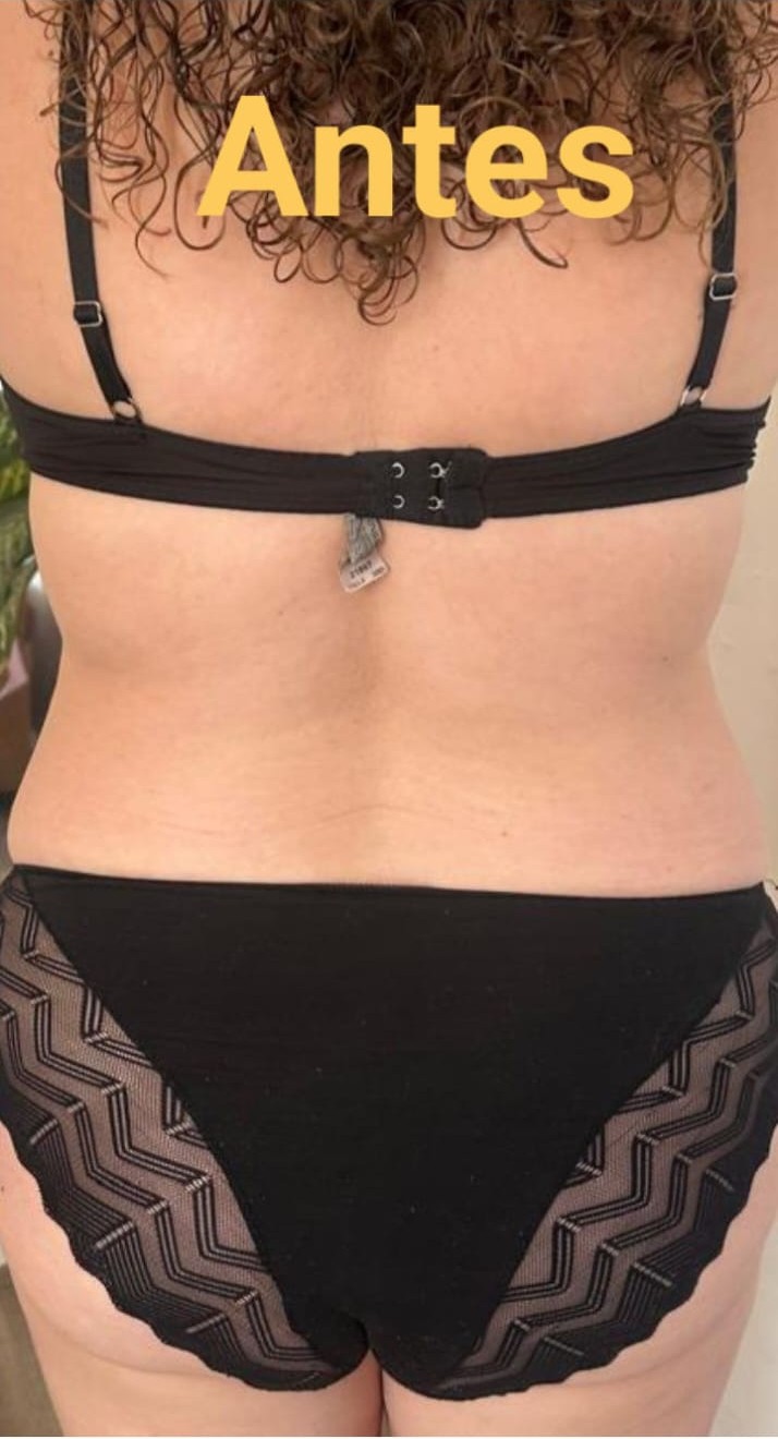 Antes del tratamiento de moldeado de cintura