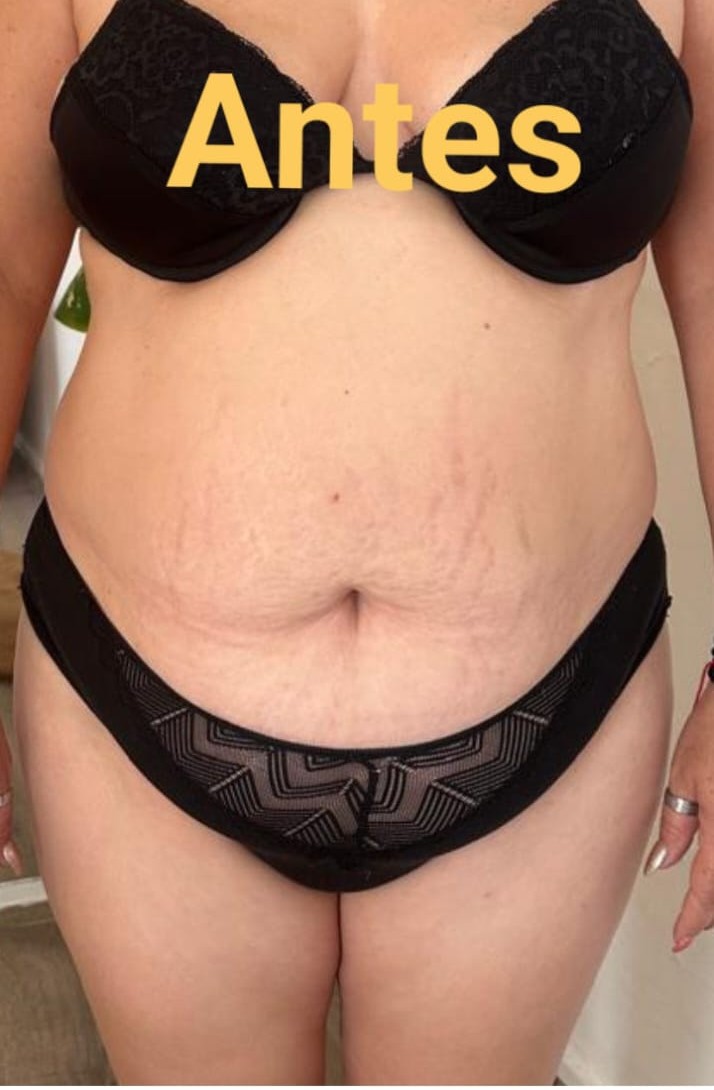 Antes del tratamiento de reducción abdominal