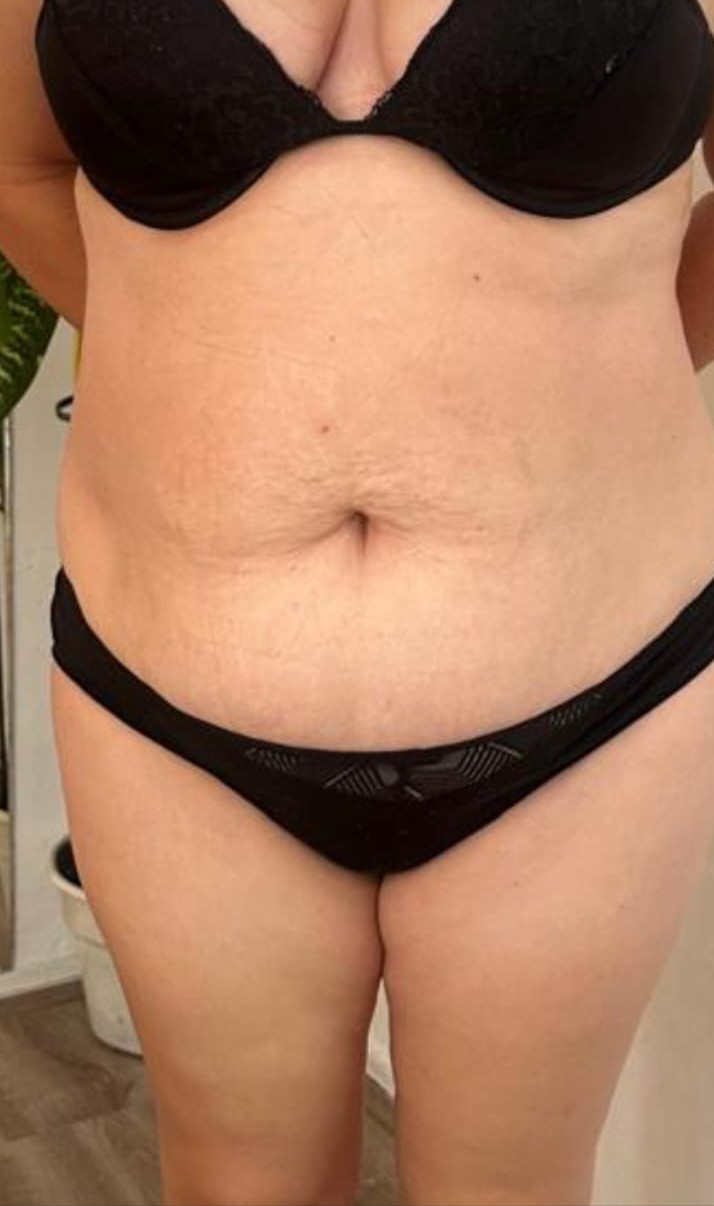 Después del tratamiento de reducción abdominal